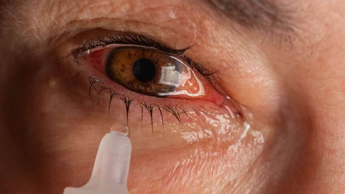 Conjunctivitis in CGNews: दस दिनों में 20 हजार से अधिक मरीज, पिंक आई के सैंपल सामान्य, वायरस में कोई बदलाव नहीं